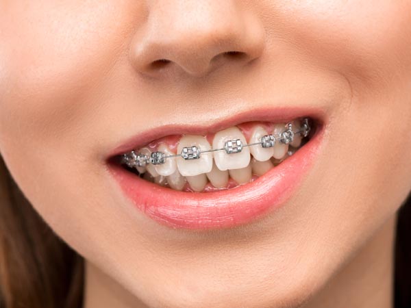 Ortodonti Tedavisi Çankaya